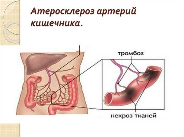 5. Другие причины некроза кишечника