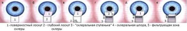 Суть процедуры