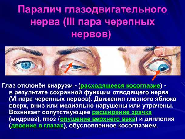 Факторы, способствующие возникновению невралгии глазодвигательного нерва
