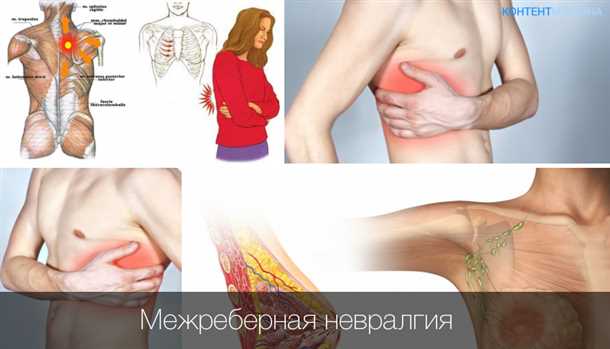 Невралгия грудного спинного нерва: клинические проявления и реабилитация.