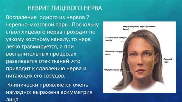 Невралгия лицевого нерва: клинические проявления и комплексное лечение.