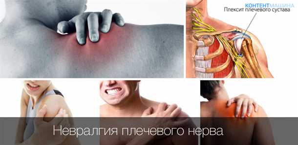Невралгия лучевого плечевого нерва: симптомы и реабилитация.