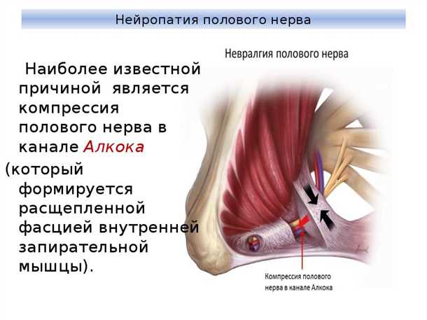 Невралгия пахового сплетения: диагностика и комплексное лечение.