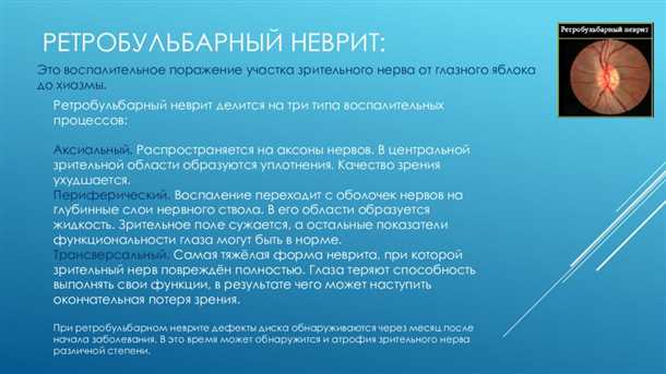 Невралгия периферического зрительного нерва: методы диагностики и лечения.