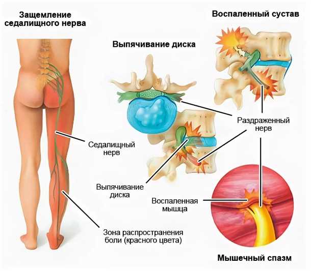 Эффективные процедуры в реабилитации при невралгии позвоночного колонного нерва