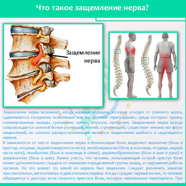 Невралгия позвоночного колонного нерва - опасное и болезненное состояние, проявляющееся через разнообразные симптомы и требующее комплексного подхода к реабилитации Невралгия позвоночного колонного нерва: симптомы и подходы к реабилитации.