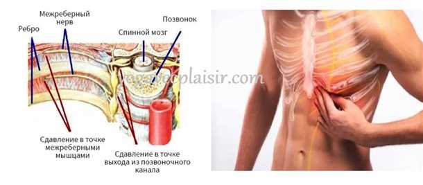 Диагностика невралгии сакрального сплетения