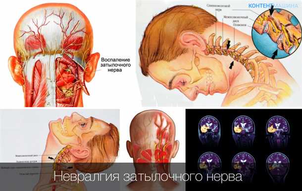 Невралгия сакрального сплетения: симптомы и подходы к терапии.