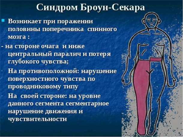 Основные симптомы невралгии спинного мозга