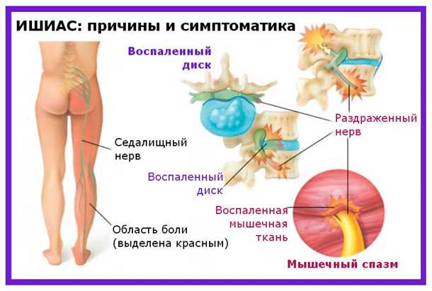 Невралгия тазового сплетения: симптомы и подходы к лечению.
