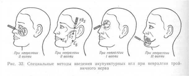 Невралгия тригеминального нерва: симптомы и подходы к реабилитации.