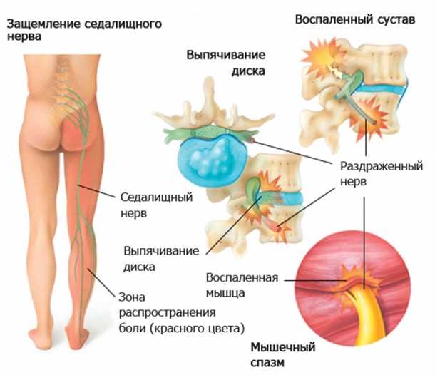 Методы лечения невралгии в области живота