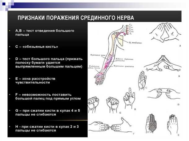  Факторы риска развития невралгии запястного нерва 