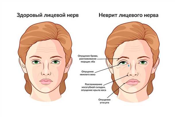 Фармакологические методы лечения аутоиммунных невритов и невропатий