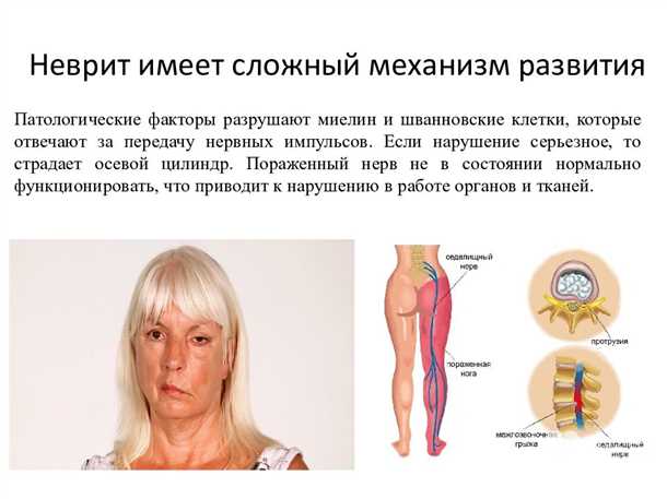 Невриты и невропатии при хронических воспалительных заболеваниях: механизмы и терапия.
