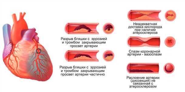 Роль нервной системы в развитии инфаркта миокарда