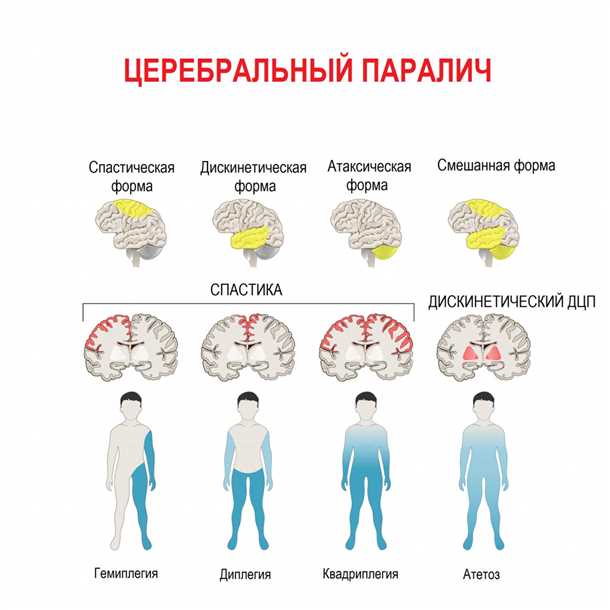 Развитие детского церебрального паралича: путь к пониманию и прогнозированию