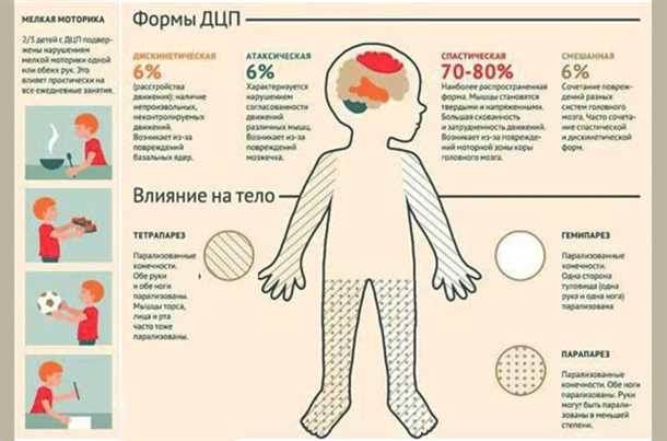 Неврологические аспекты детского церебрального паралича
