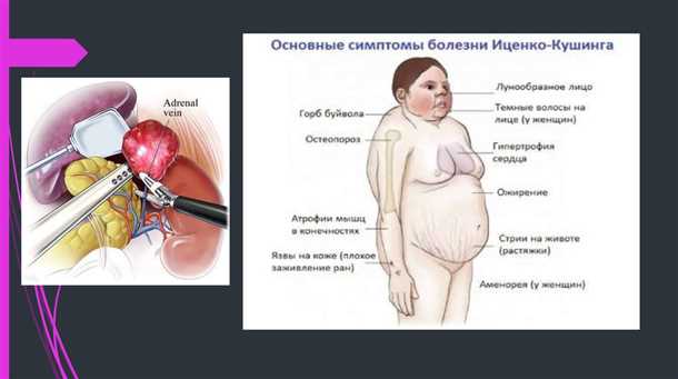 Неврологические аспекты при детских поражениях надпочечников.