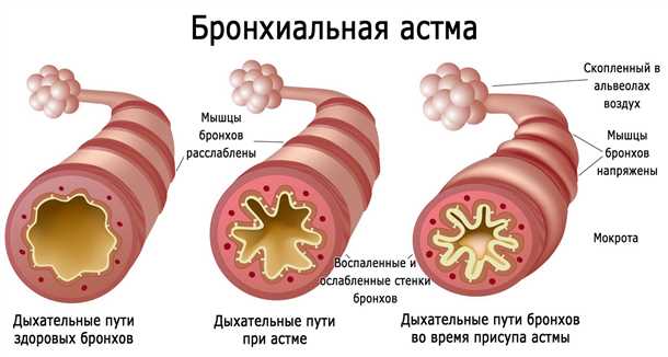 Роль нервной системы в регуляции функционирования организма при бронхиальной астме у детей