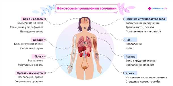 Неврологические аспекты системных заболеваний соединительной ткани (например, системная красная волчанка)