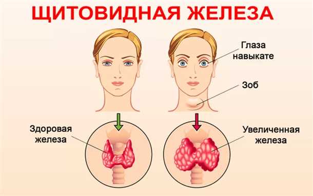 Связь избыточного функционирования щитовидной железы с неврологическими расстройствами