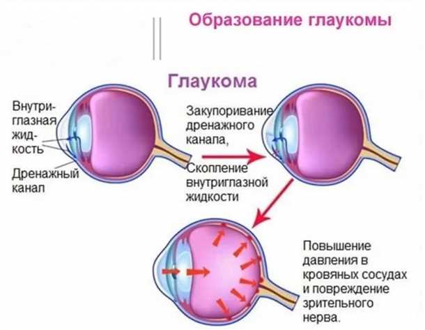Предотвращение потери зрительной функции