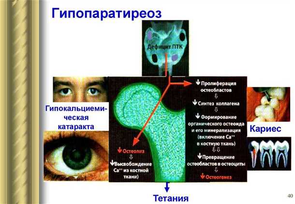 Влияние гипопаратиреоза на нервную систему