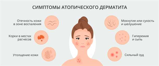 Сонные расстройства и аллергическое воспаление кожи