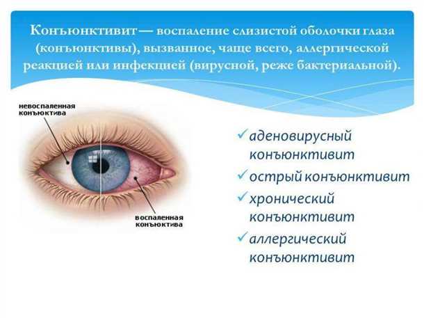 Неврологические проявления при детском аллергическом конъюнктивите.
