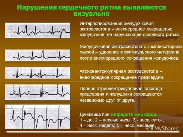 Влияние сердечных аритмий на психическое состояние