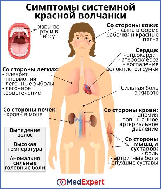 Влияние системной красной волчанки на центральную нервную систему