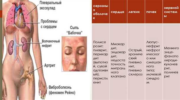 Влияние системной красной волчанки на нервную систему