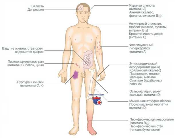Неврологические симптомы при аутоиммунных заболеваниях желудочно-кишечного тракта.