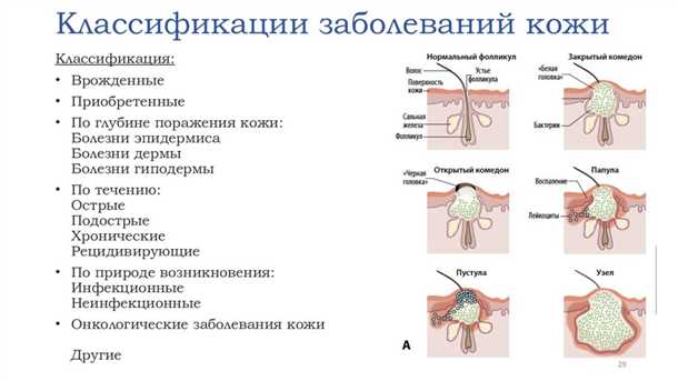 Лечение неврологических проявлений при инфекционных заболеваниях кожи