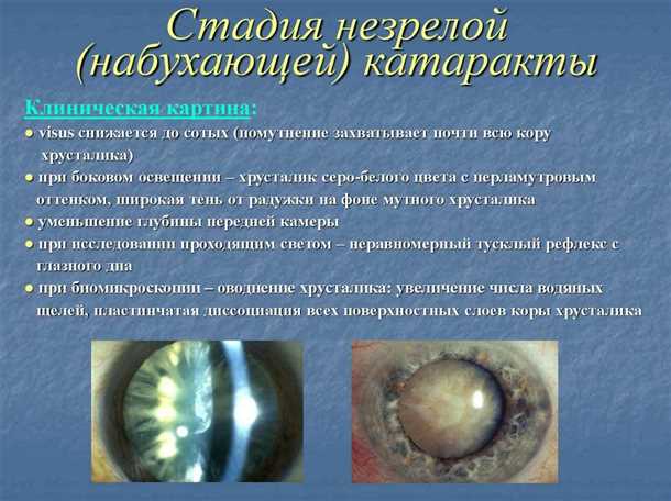 Лечение незрелой катаракты