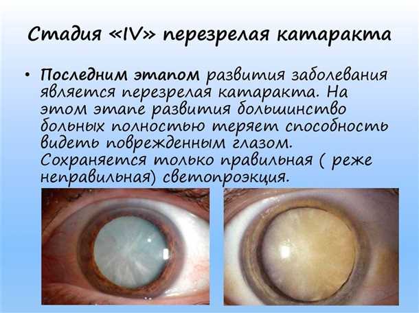 Симптомы незрелой катаракты глаз