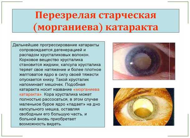Незрелая катаракта глаз – симптомы и лечение