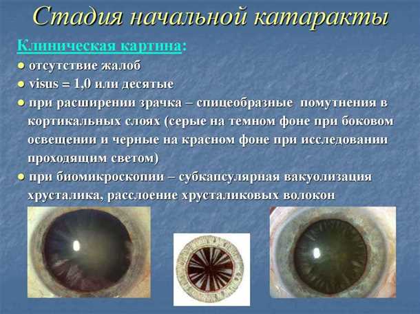 Незрелая катаракта глаз – симптомы и лечение