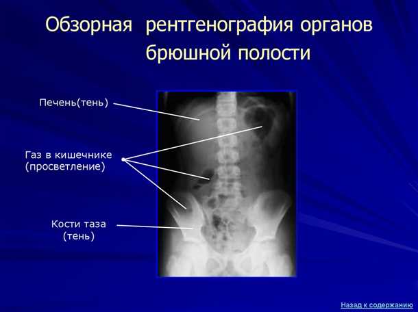 Проведение обзорной рентгенографии брюшной полости