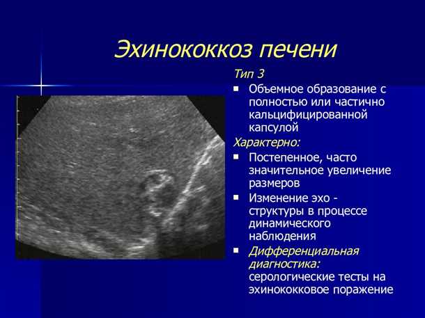 Профилактика образования очагов в печени