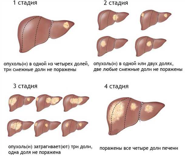 Причины возникновения онкологии печени