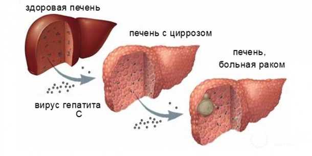 Онкология печени лечение