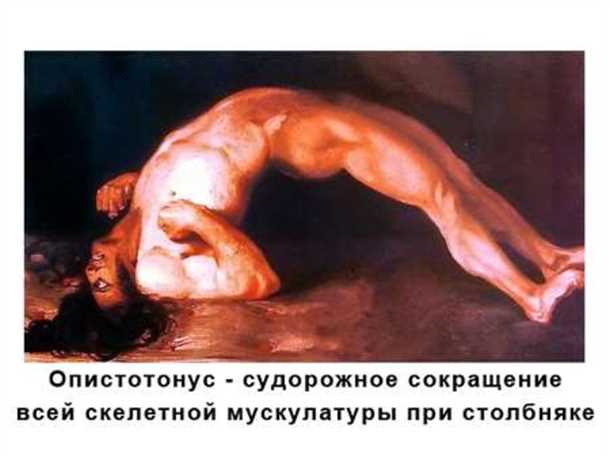 Опистотонус