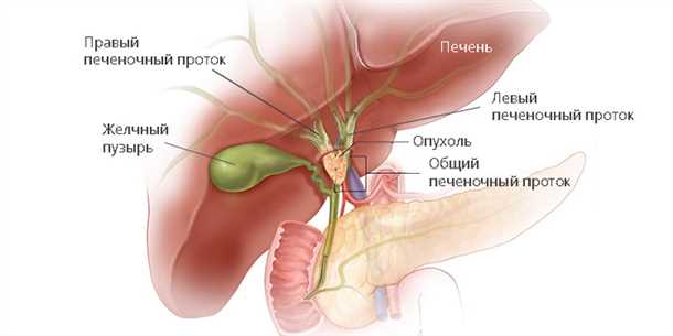 Лечение опухоли Клацкина