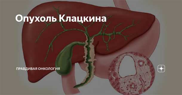 Опухоль клацкина