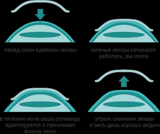 Инструкция по использованию ортокератологических линз