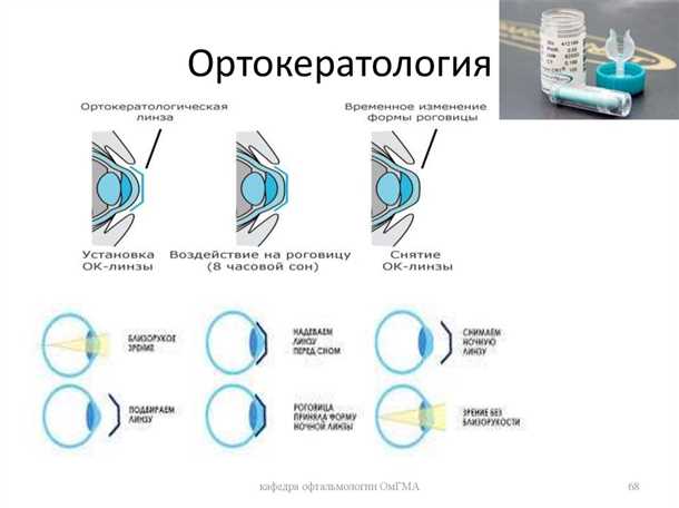 Ортокератологические линзы: основные преимущества