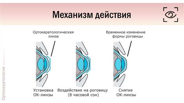 Ортокератология (orthokeratology), инструкция , цены и отзывы.