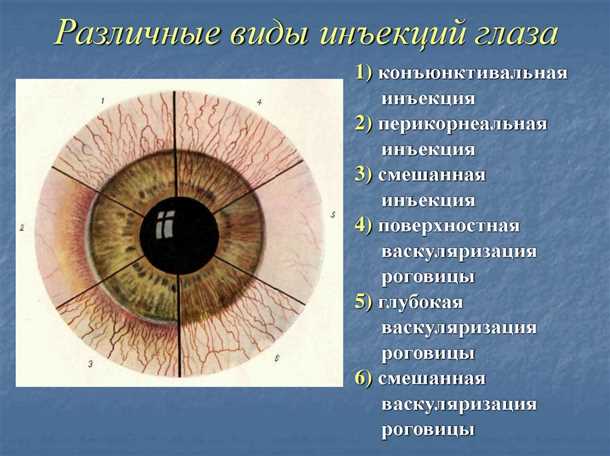 Развитие катаракты